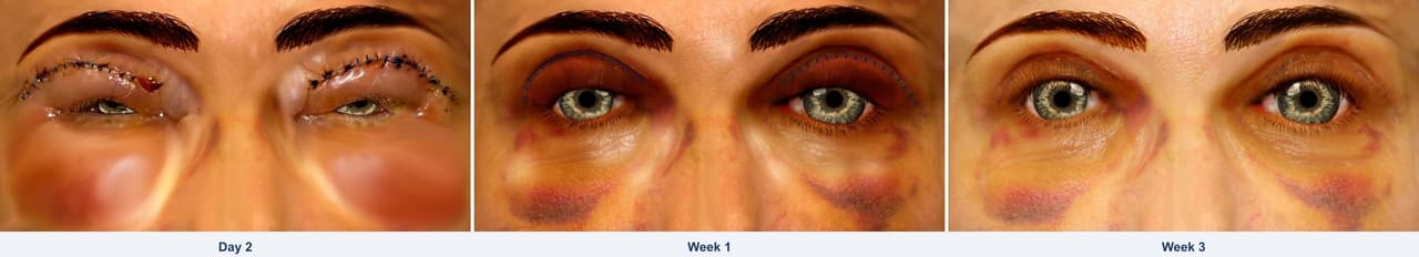 Patient applying cold compress to eyelids after blepharoplasty surgery